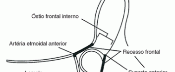 Cirugía del seno frontal – Urquiola Federico Adolfo  – 2006 Objetivos – Describir la compleja anatomía del seno frontal, tanto en su configuración externa como […]