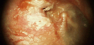 Colesteatoma de Ático – Seno lateral trombosado 1-Descripción: Paciente femenino de 32 anos de edad que tiene antecedentes de otorrea y otalgia en oído derecho, […]