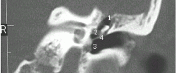 Atelectasia – Líquido en caja y cavidades Paciente femenino de 45 años de edad Oído Derecho Perforación mesotimpanica Oído Izquierdo Otopatía adhesiva Sensación de falta […]