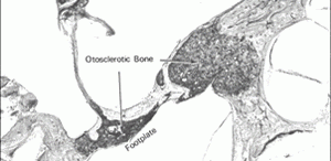 La Otoesclerosis y su Tratamiento Quirúrgico – Di Lella Federico Alberto – 2006   “La Otoesclerosis y su Tratamiento Quirúrgico: Una visión del camino recorrido […]