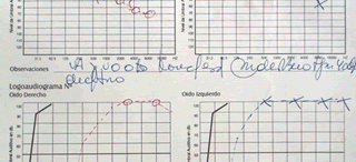 Lipoma del conducto auditivo interno 1-Descripción: Los lipomas de conducto auditivo interno son tumores de muy baja presentacion. Su origen estaria en relacion con una […]