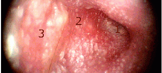 Tromboflebitis del seno lateral Otoscopia oído derecho 1-Membrana timpánica mas edematizada e su mitad posterior 2-Mango del martillo inflamado 3-Pared posterior del conducto edematizada por […]